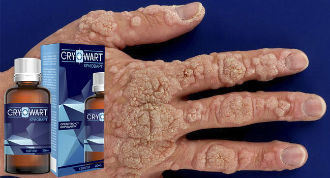 Cryowart от папиллом и бородавок отзывы